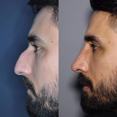 Slider image (1) Istanbul Rhinoplasty Center / Assoc. Prof. Dr. Mehmet Emre Dinc